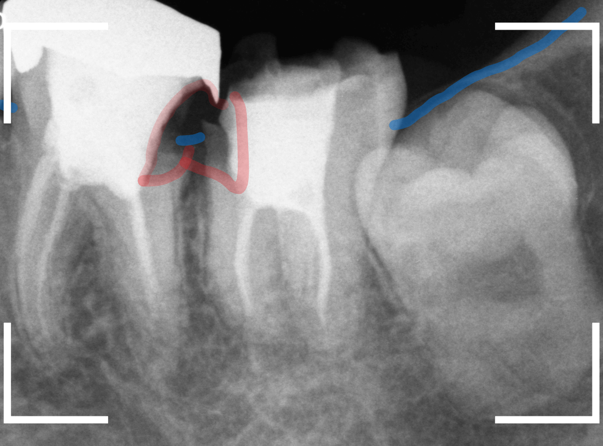 気づかないうちに深い虫歯15-2
