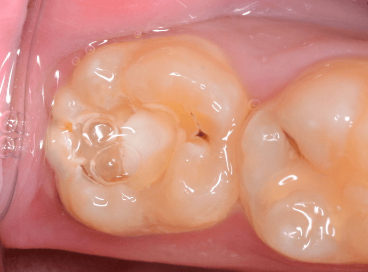 つめものの下の深い深い虫歯11-1