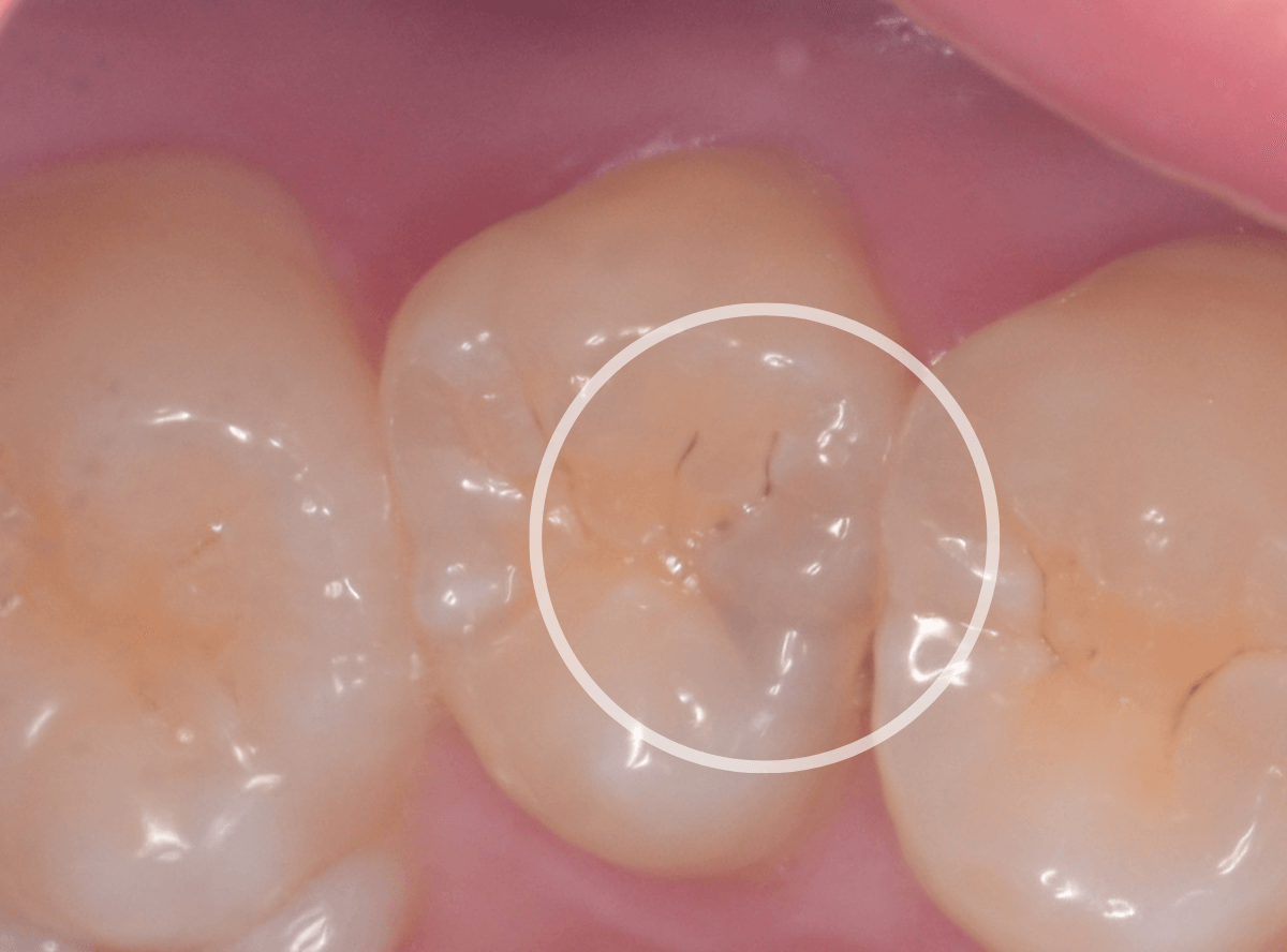 レントゲンでわかりづらい虫歯2-1