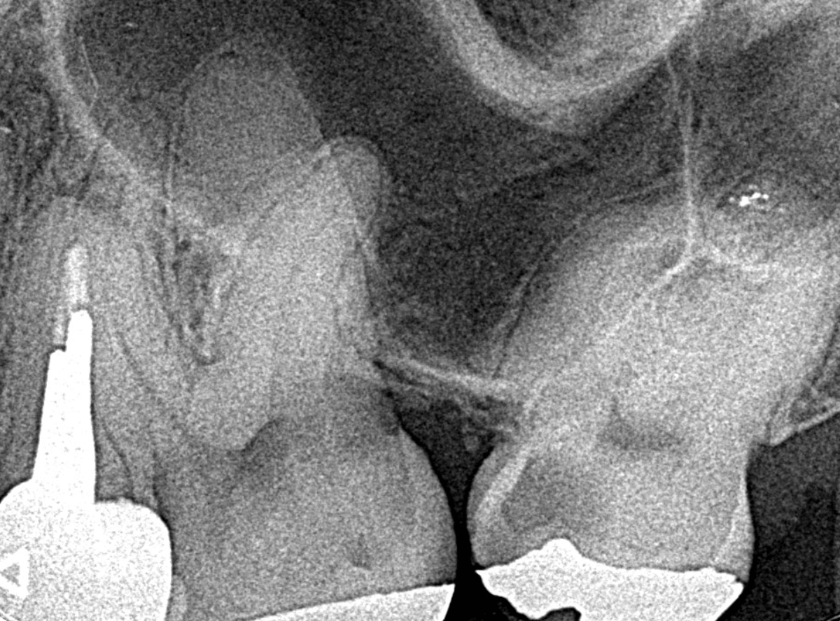 つめものの下の深い虫歯(画像)4-3