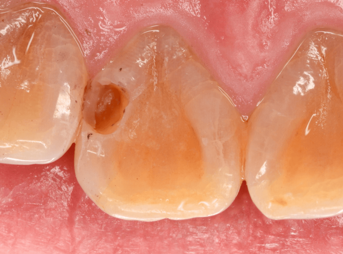 コンポジットレジン治療5-3