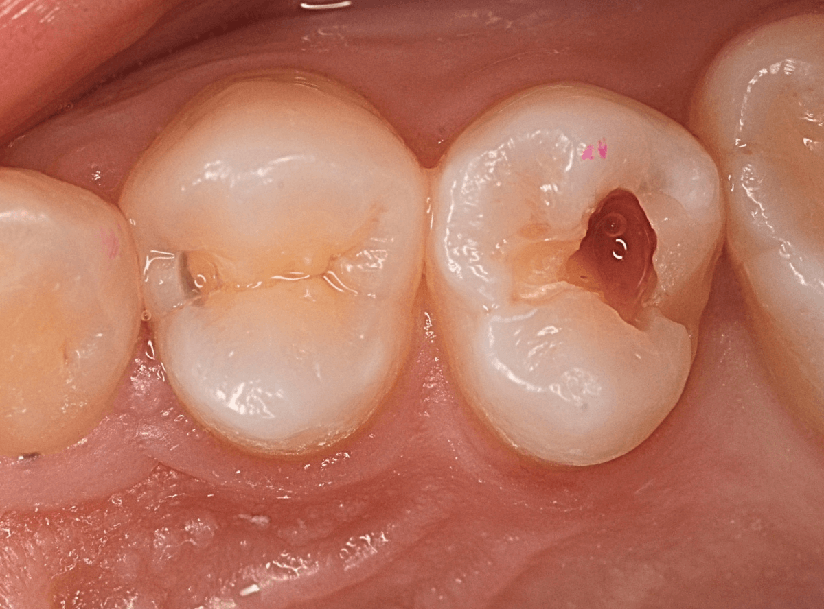 つめものの下の深い深い虫歯11-1