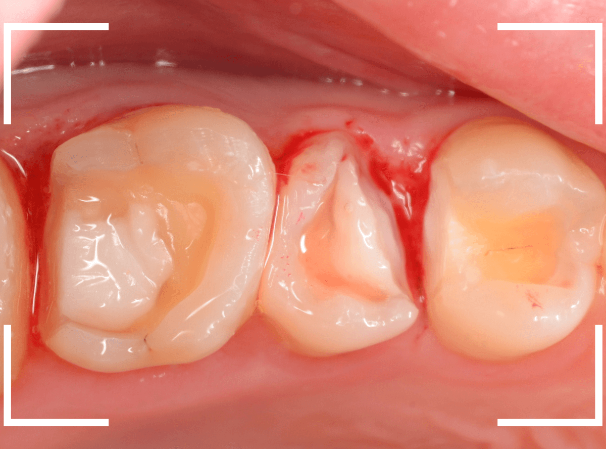 セラミック治療(インレー)32-10