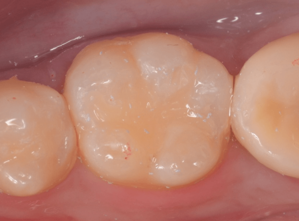 コンポジットレジン治療1-3