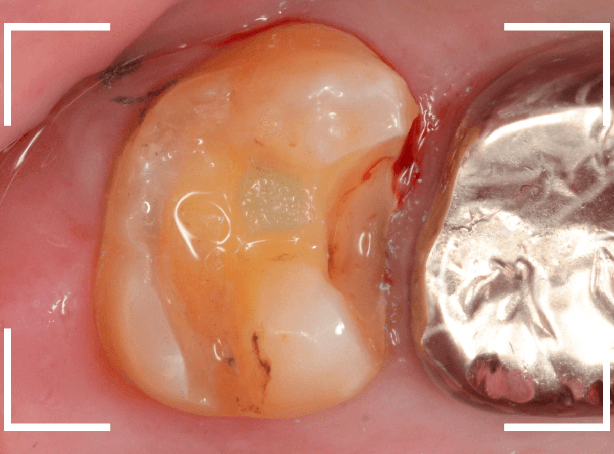 歯と歯の間の虫歯14-5