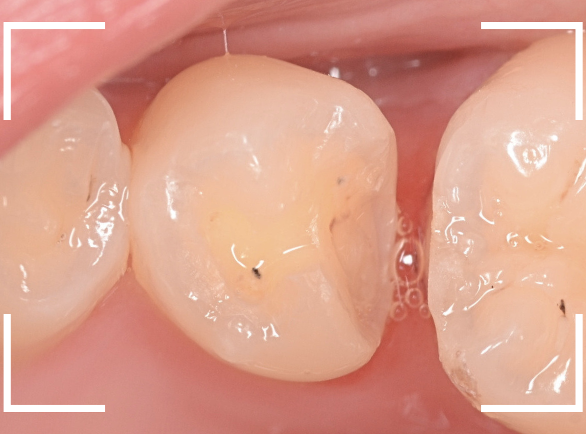 セラミック治療(インレー)23-5