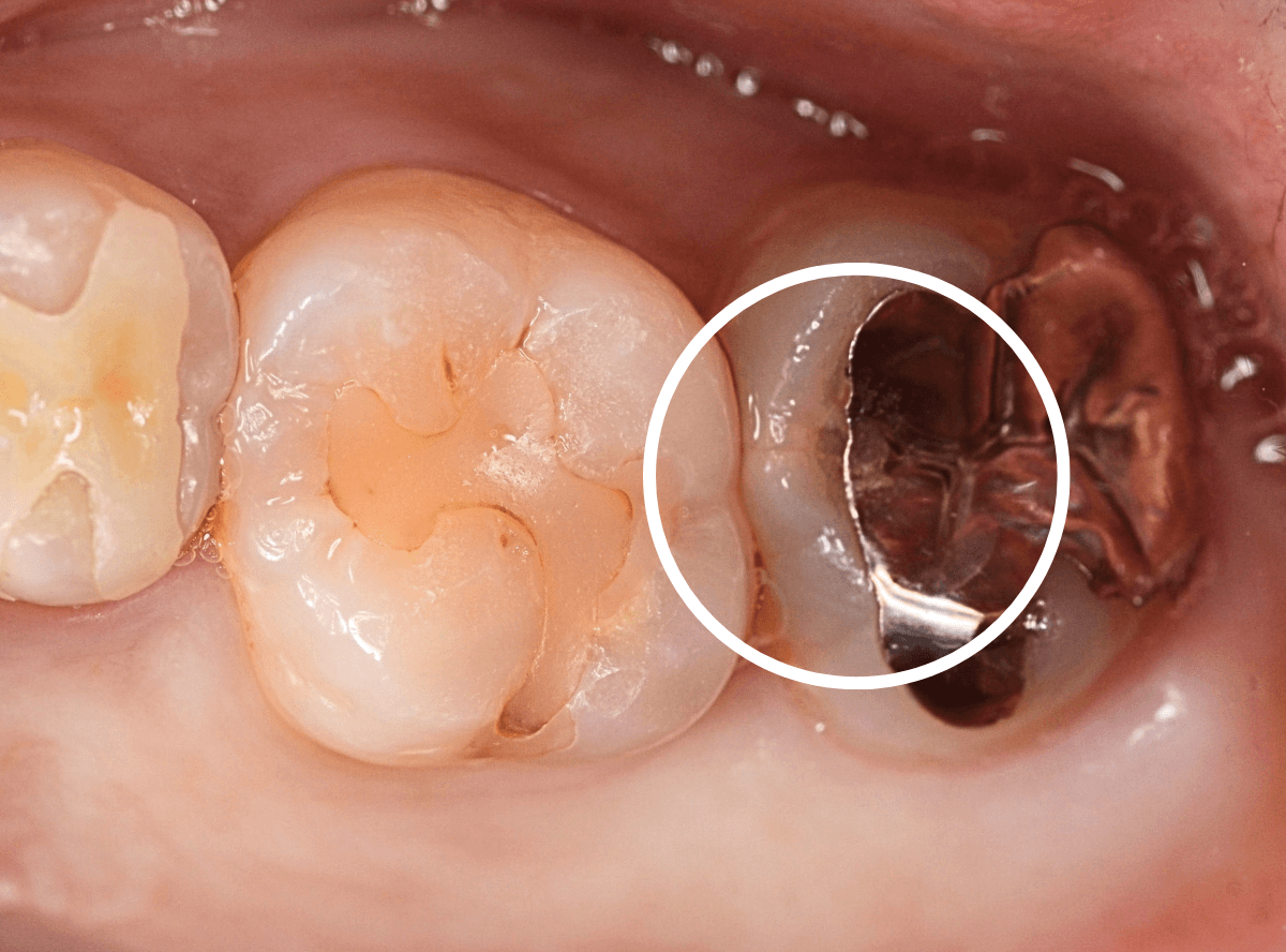 +つめものの下の深い虫歯(画像)7-1