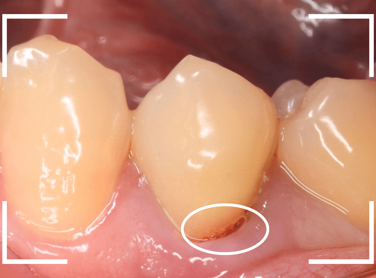 歯頚部う蝕の治療3