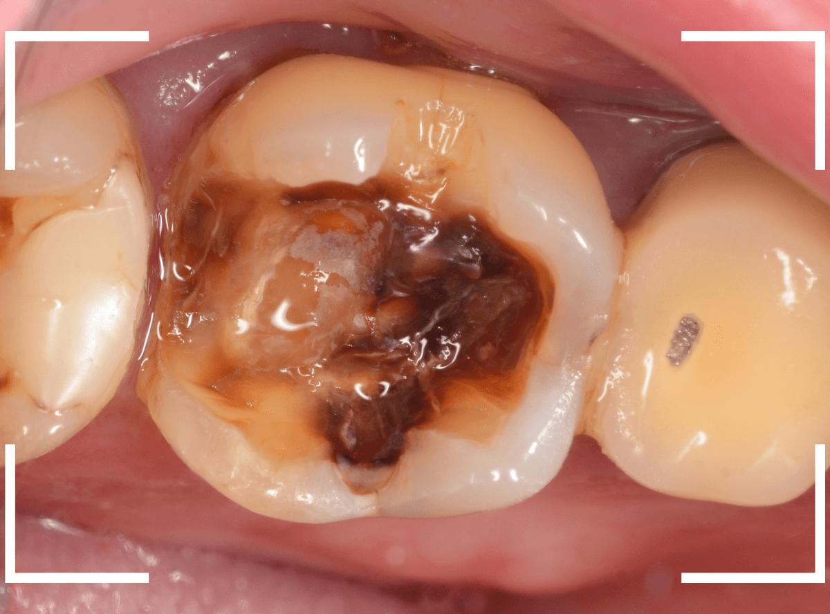 レントゲンでわかりづらい虫歯19-3
