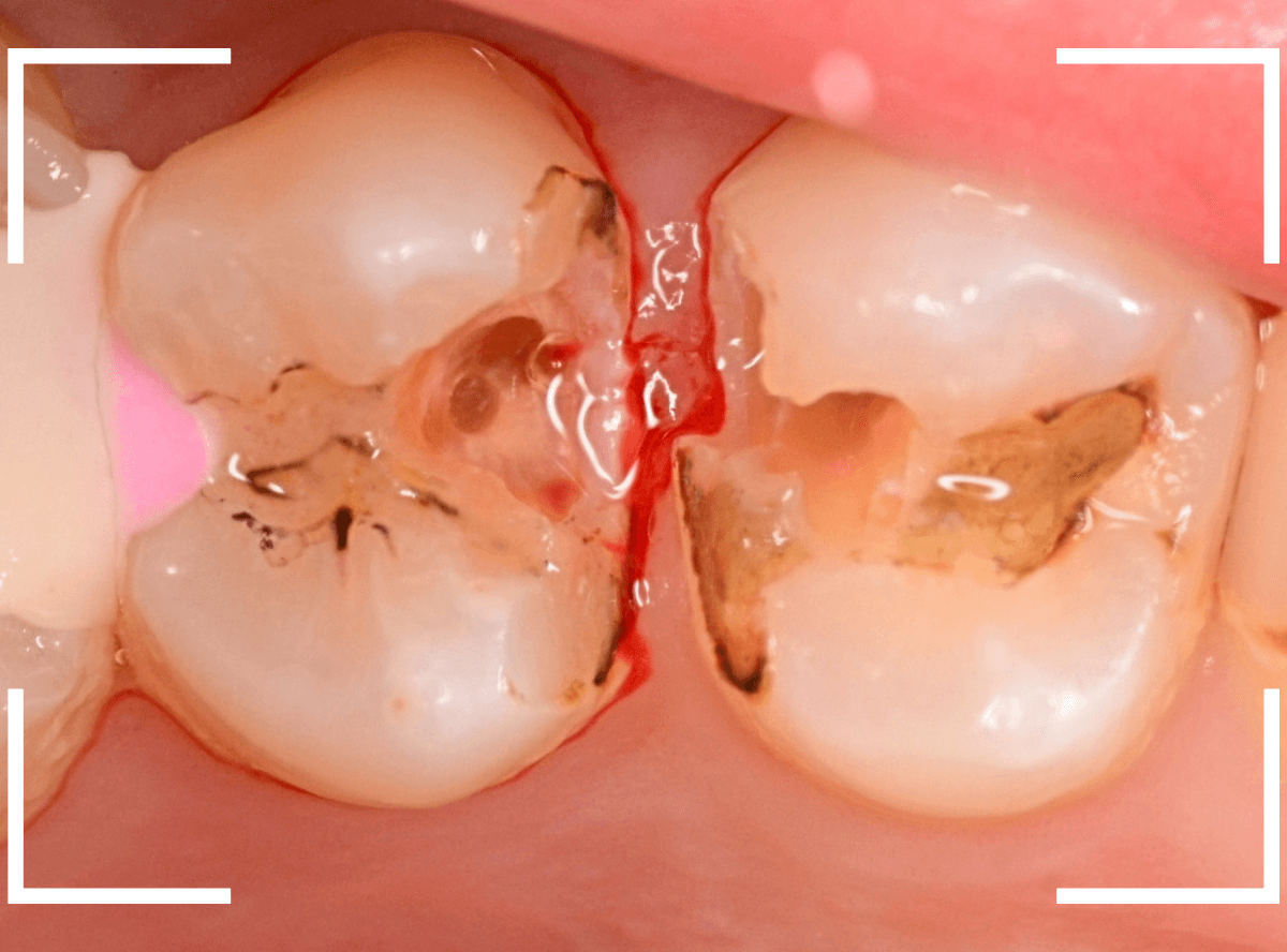 つめものの下の深い虫歯(画像)10-1