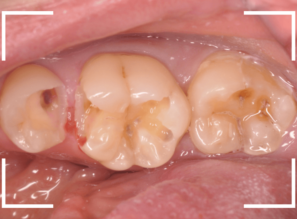 歯の治療の器具_ベースセメント-5