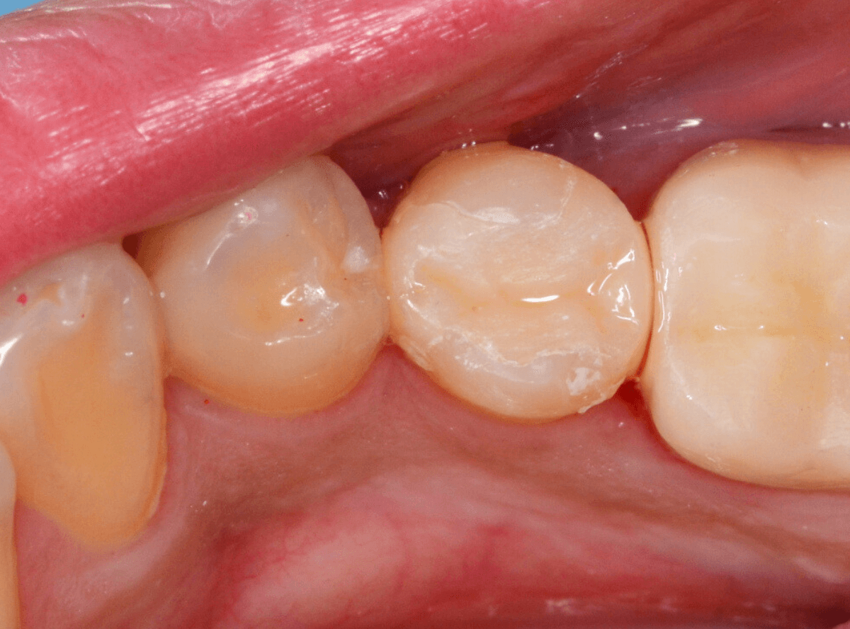 セラミック治療(インレー)5-3