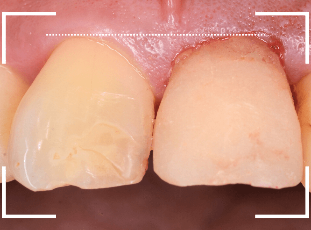 セラミック治療(前歯・クラウン)5-8