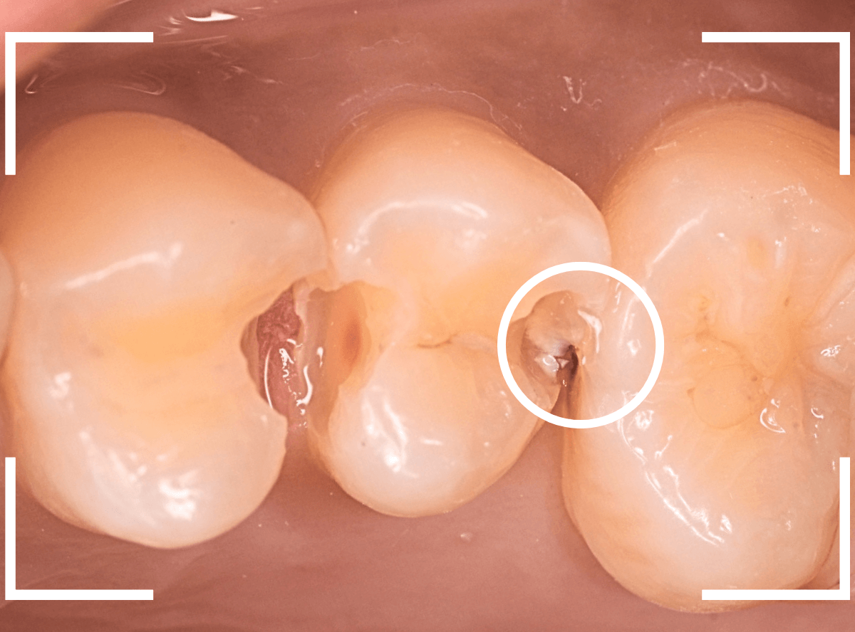 レントゲンでわかりづらい虫歯7-5