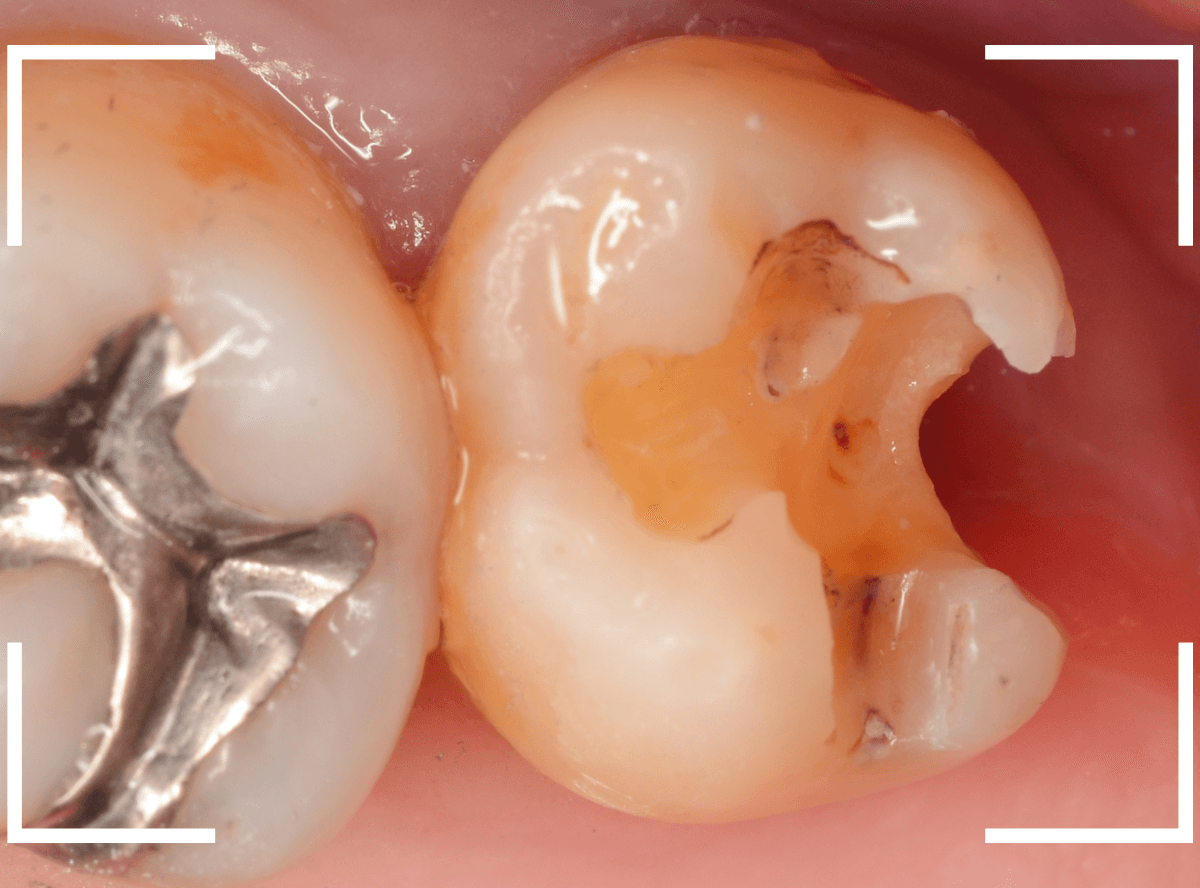 気づかないうちに深い虫歯18-5