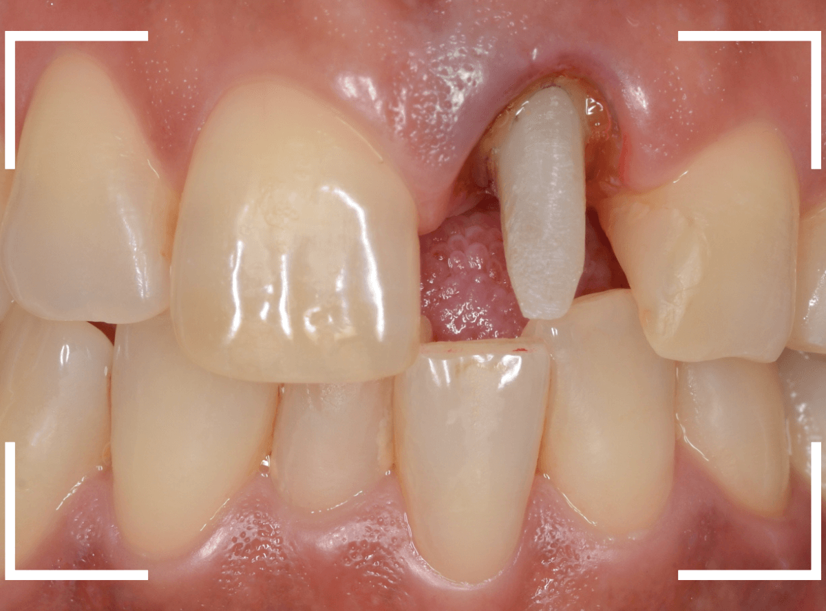 セラミック治療(前歯・クラウン)3-6