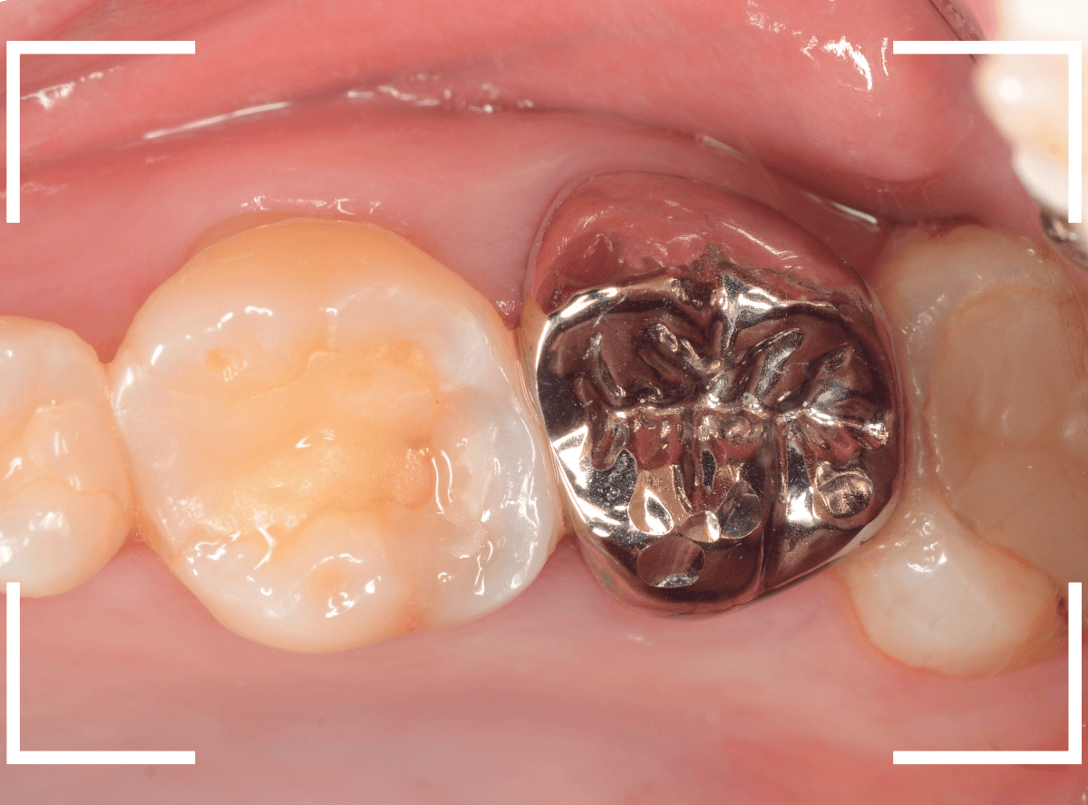 メタル・フリー治療の実際21-7