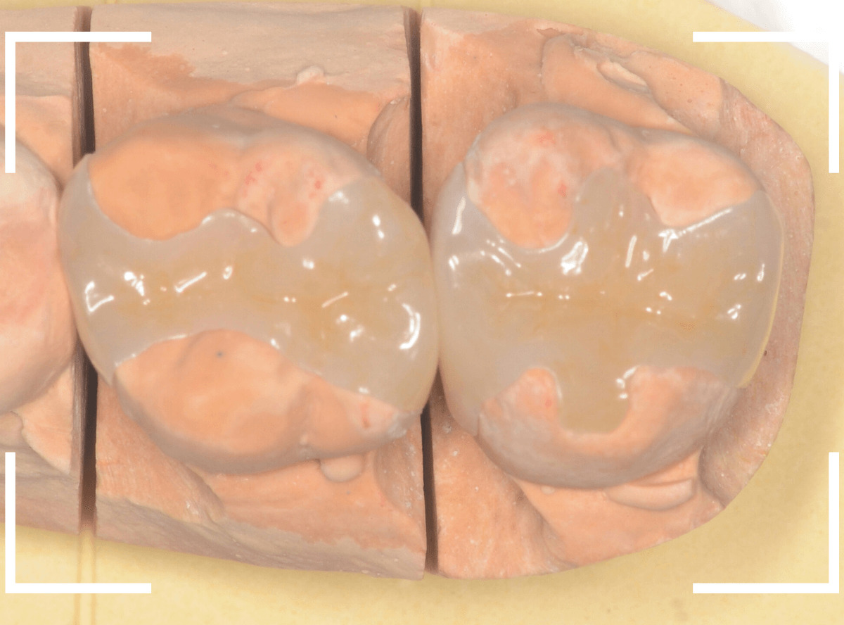 セラミック治療(インレー)31-3