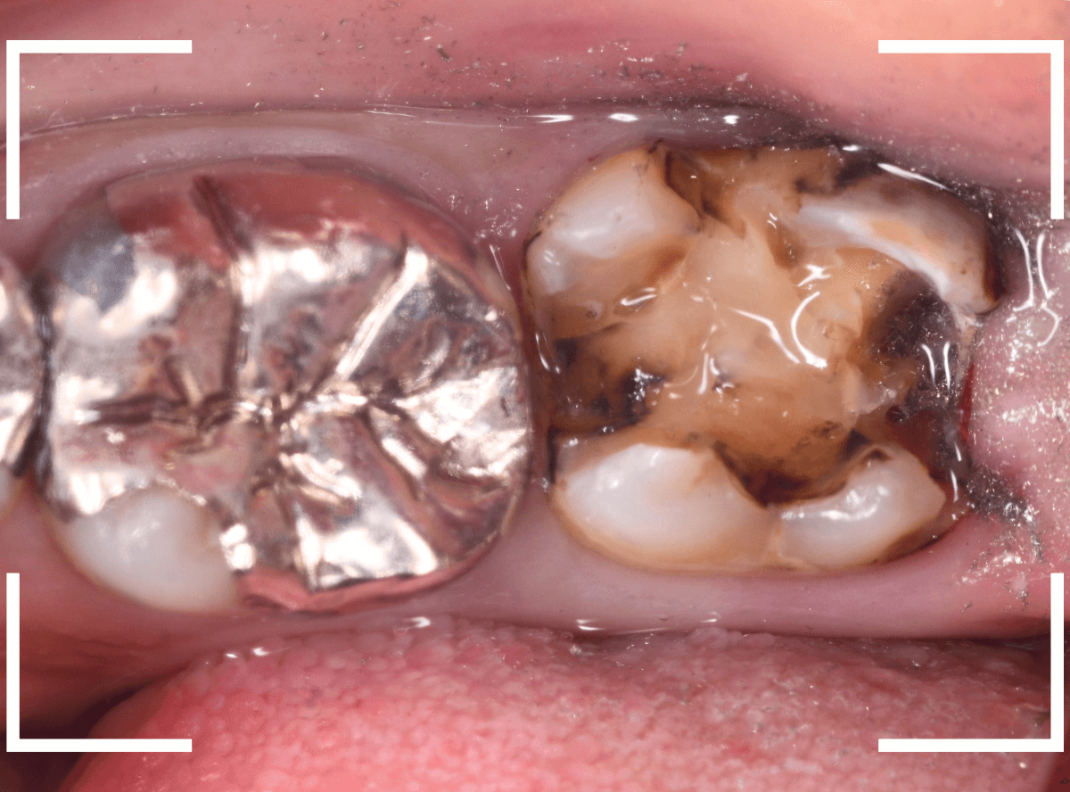 つめものの下の深い虫歯(画像)10-1
