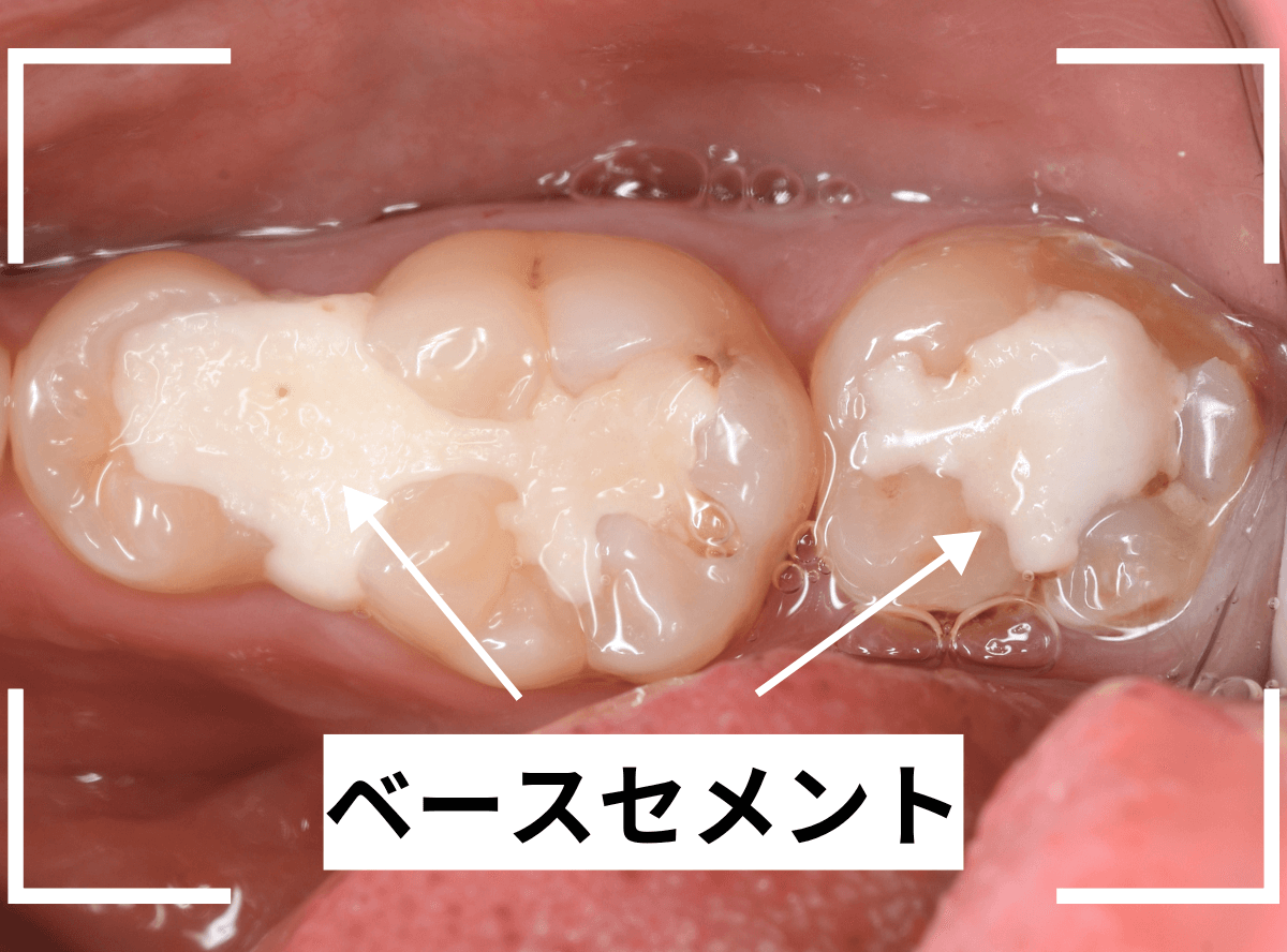 歯の治療の器具_ベースセメント-6