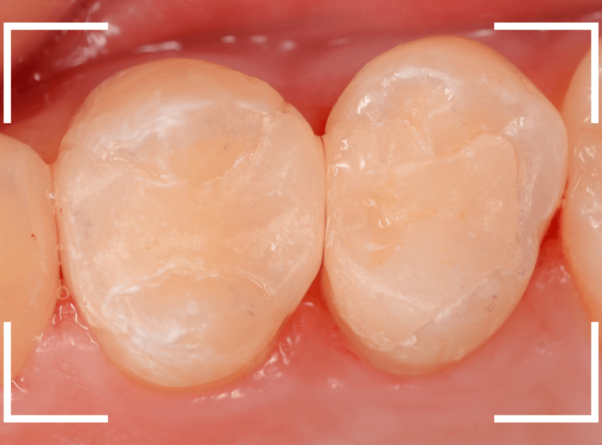 セラミック治療(インレー)28-4