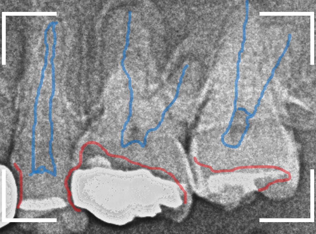 つめものの下の深い虫歯(画像)10-1