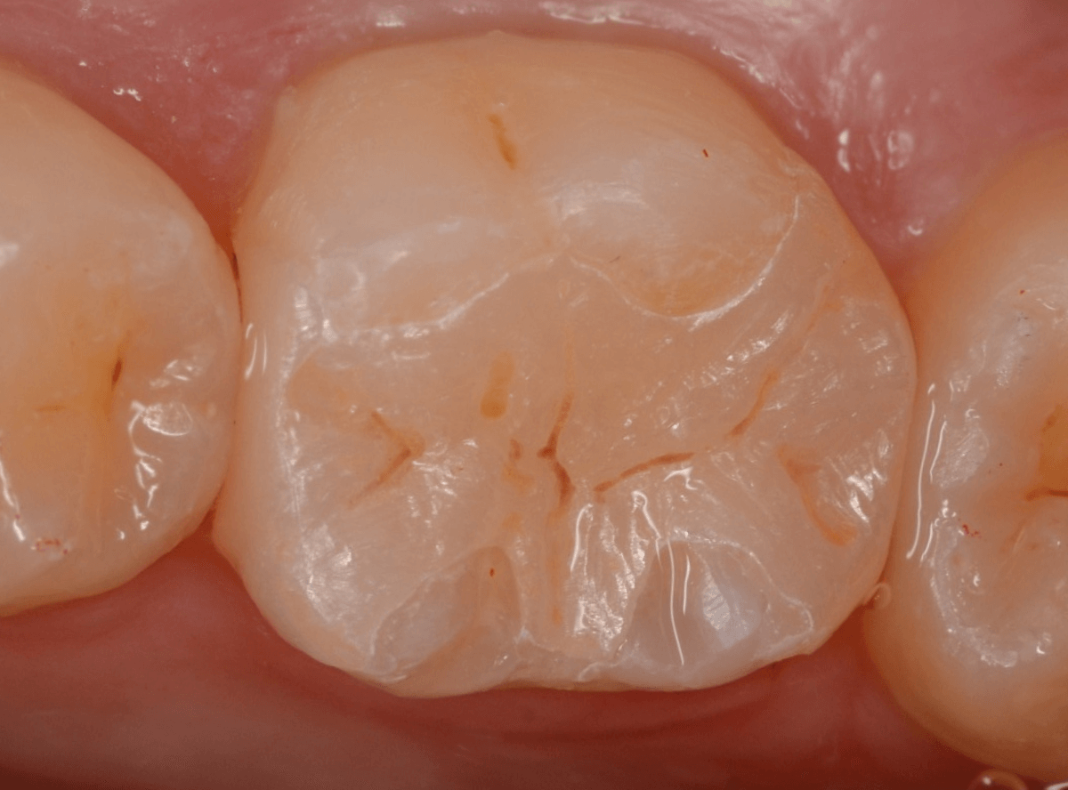 セラミック治療(インレー)10-3