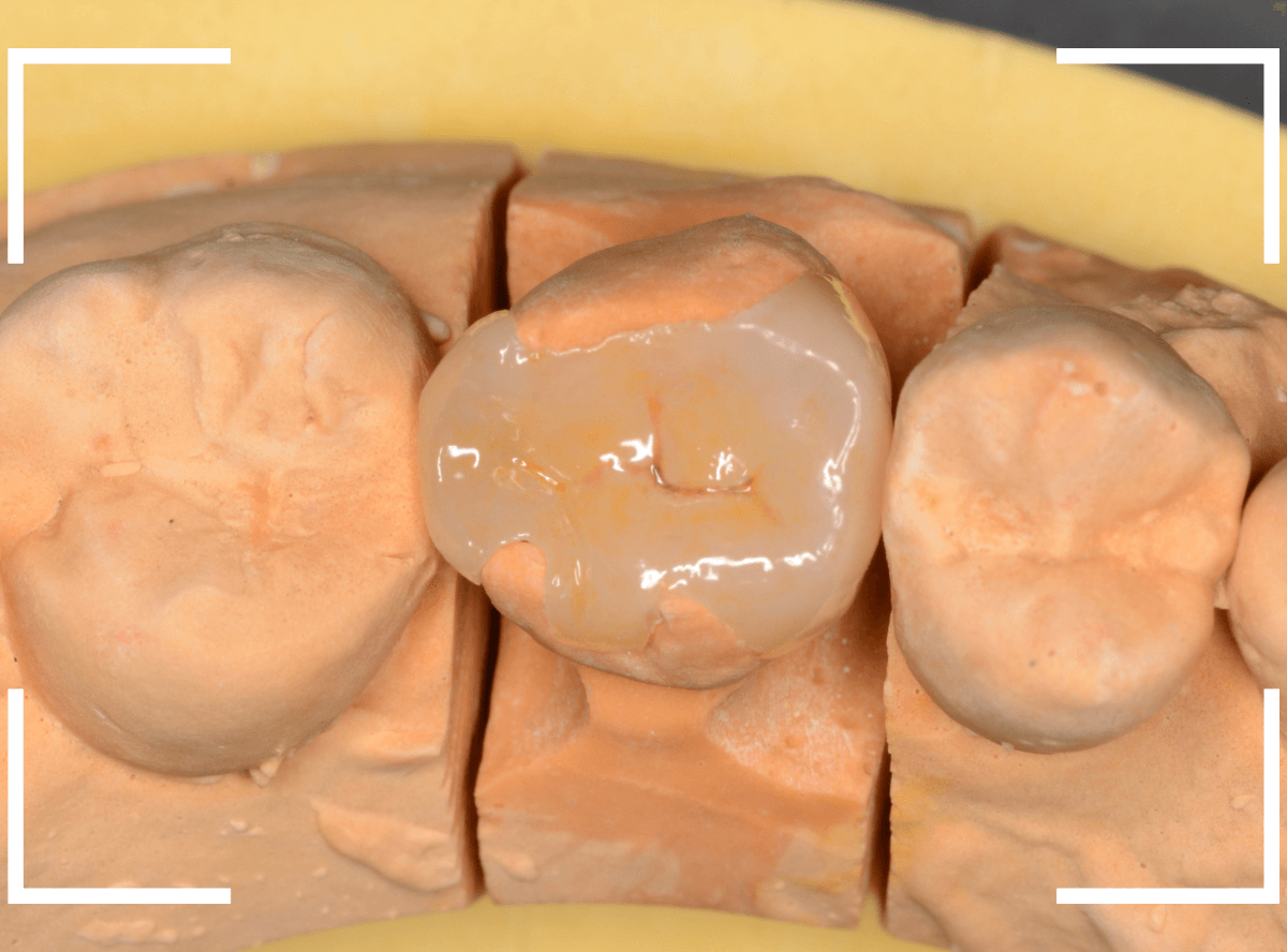 セラミック治療(インレー)35-3
