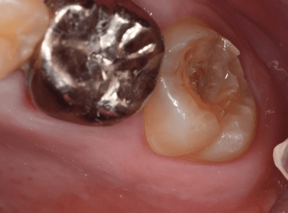 気づかないうちに深い虫歯2-3