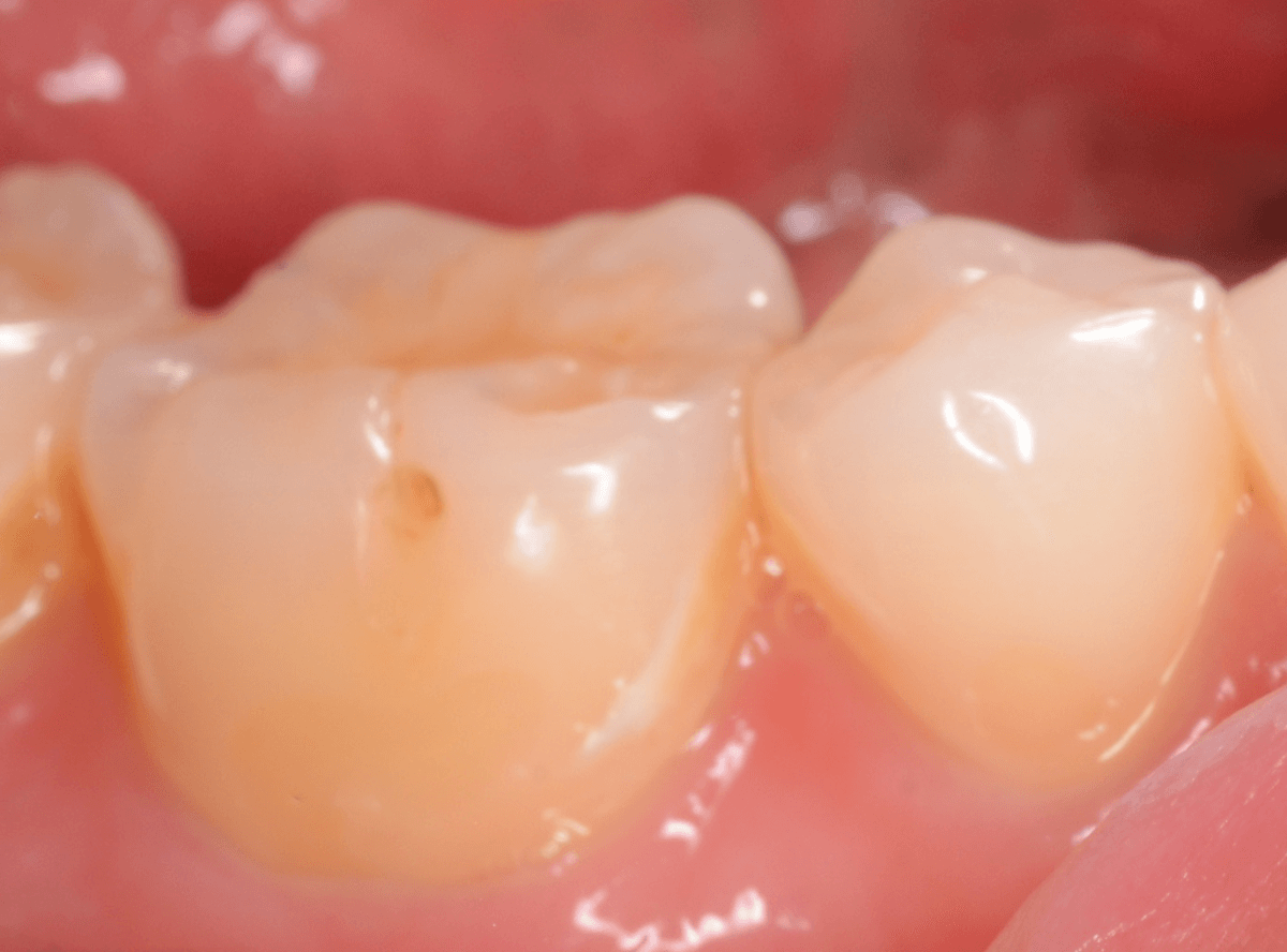 知覚過敏の画像1-3