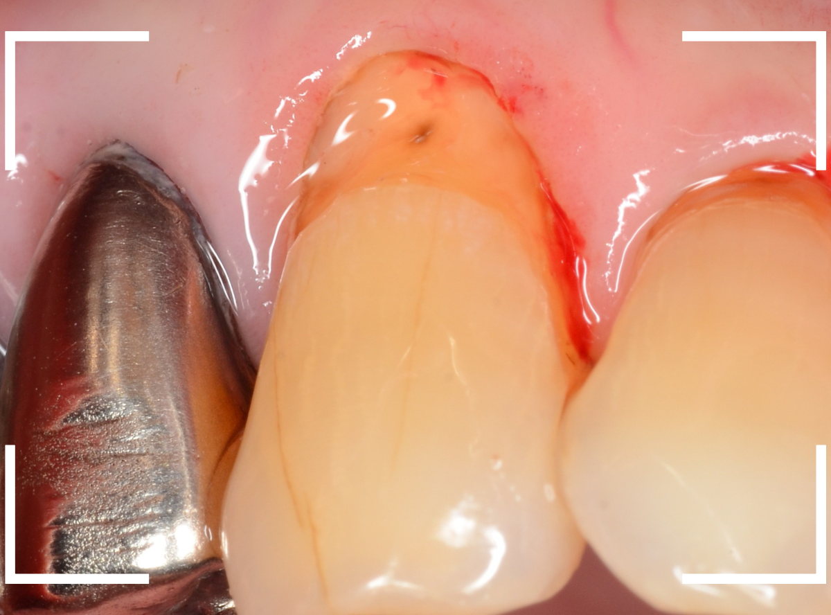 コンポジットレジン治療8-2