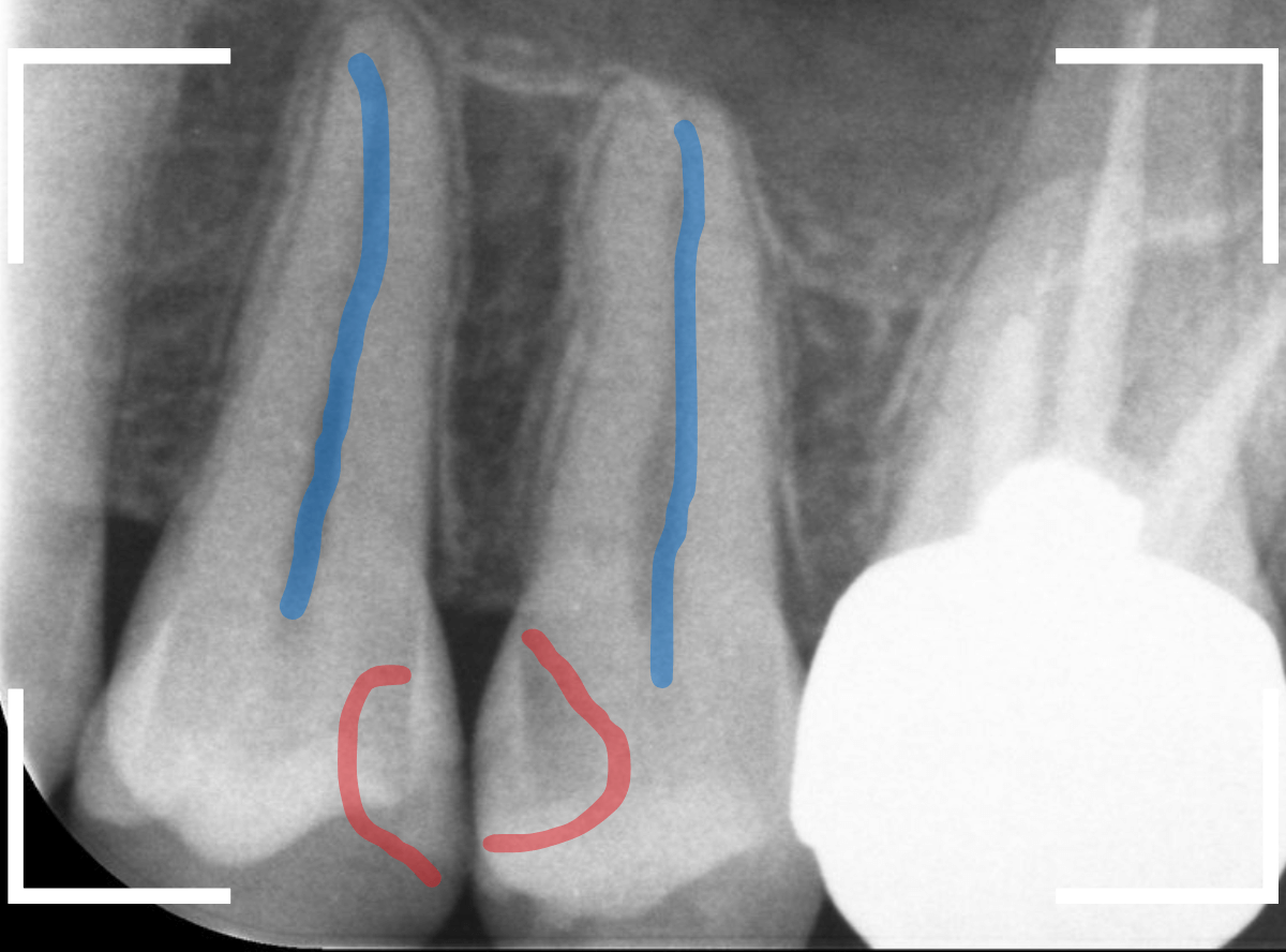 歯と歯の間の虫歯22-2