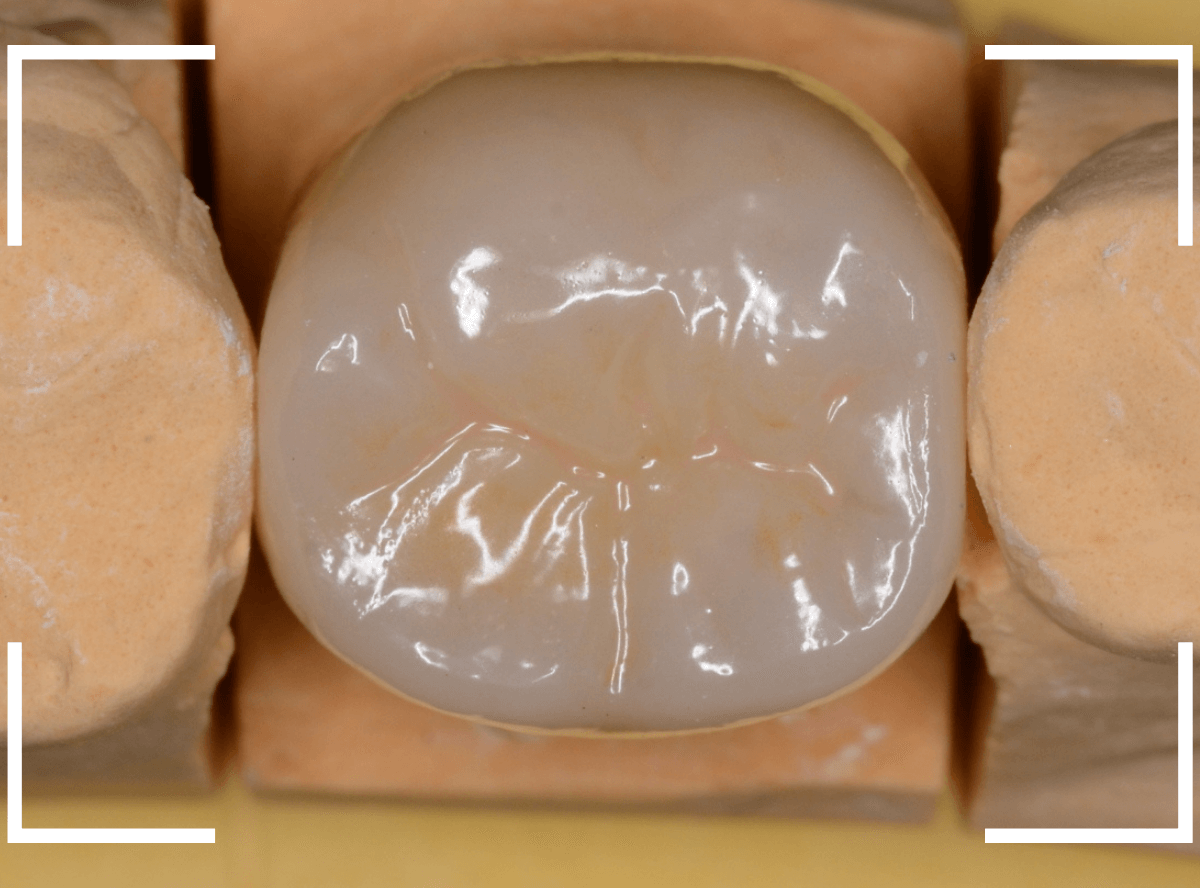 セラミック治療(クラウン・奥歯)7-5