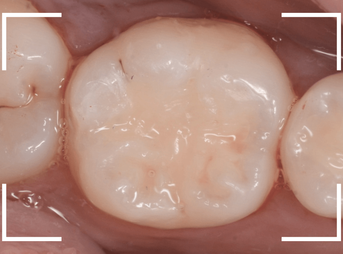 レントゲンでわかりづらい虫歯4-5