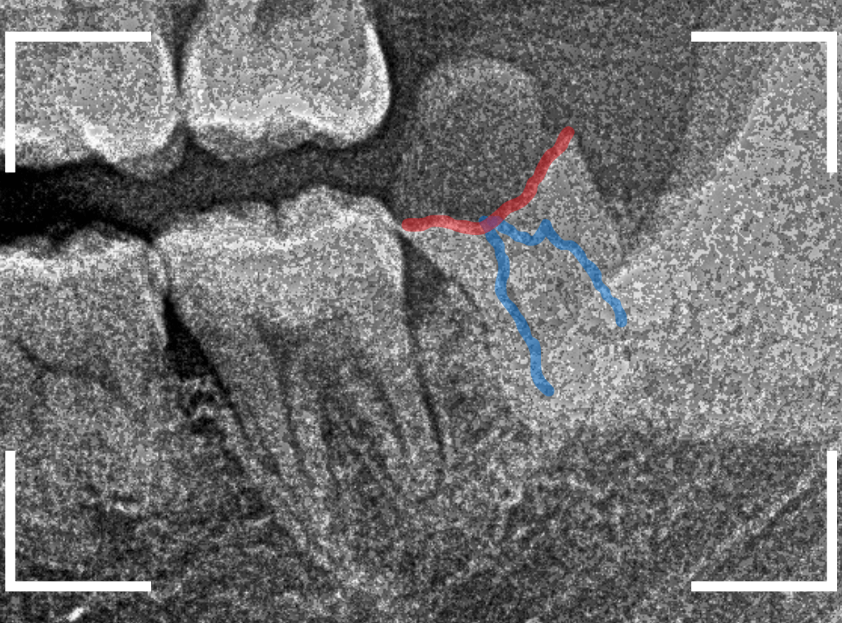 おやしらずの抜歯17-2
