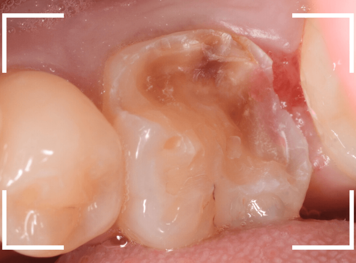 つめものの下の深い深い虫歯11-5