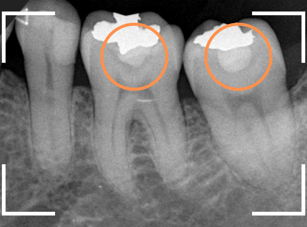 つめものの下の深い深い虫歯20-1