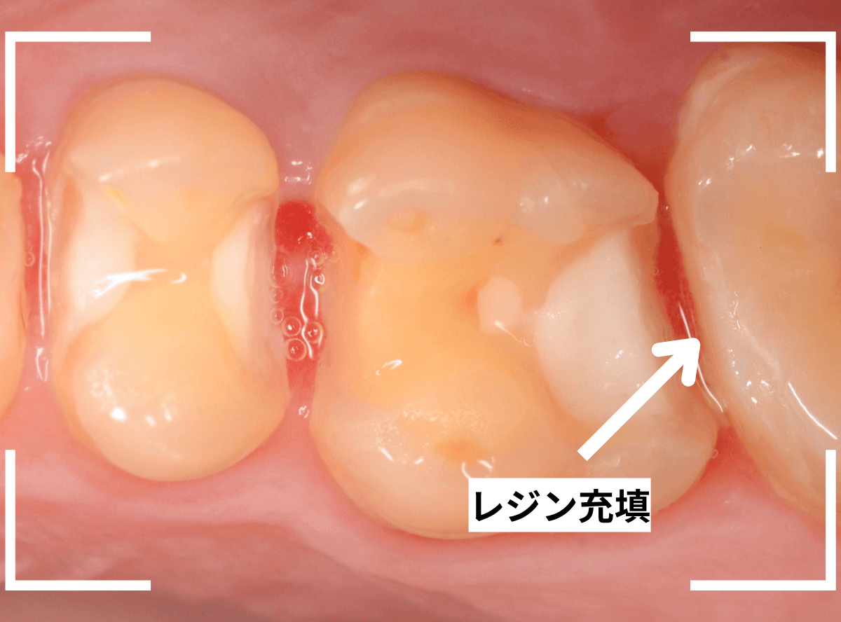 セラミック治療(インレー)24-8