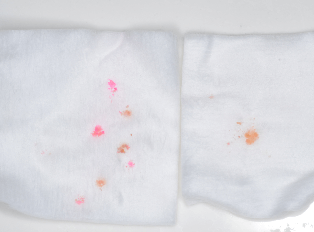 気づかないうちに深い虫歯1-5