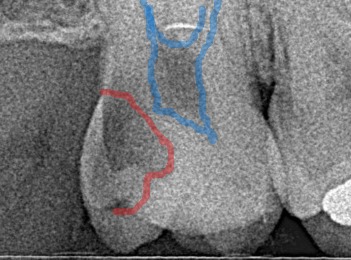 気づかないうちに深い虫歯1-3