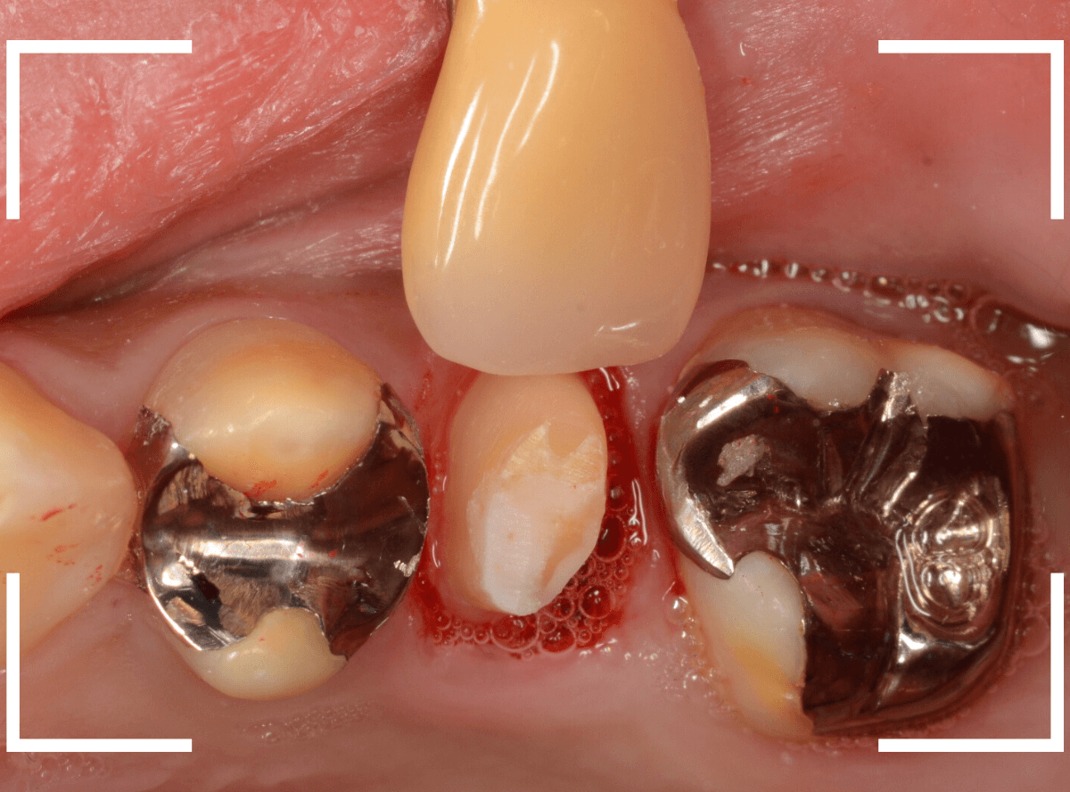 セラミック治療(クラウン・奥歯)13-2