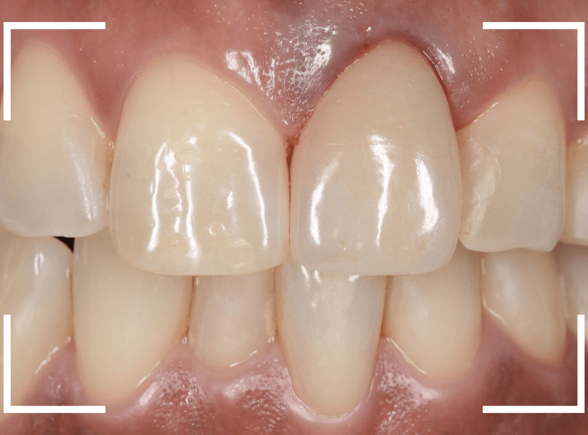 セラミック治療(前歯・クラウン)3-9