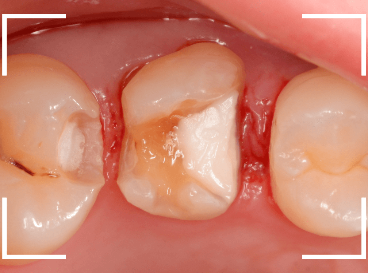 セラミック治療(インレー)35-2