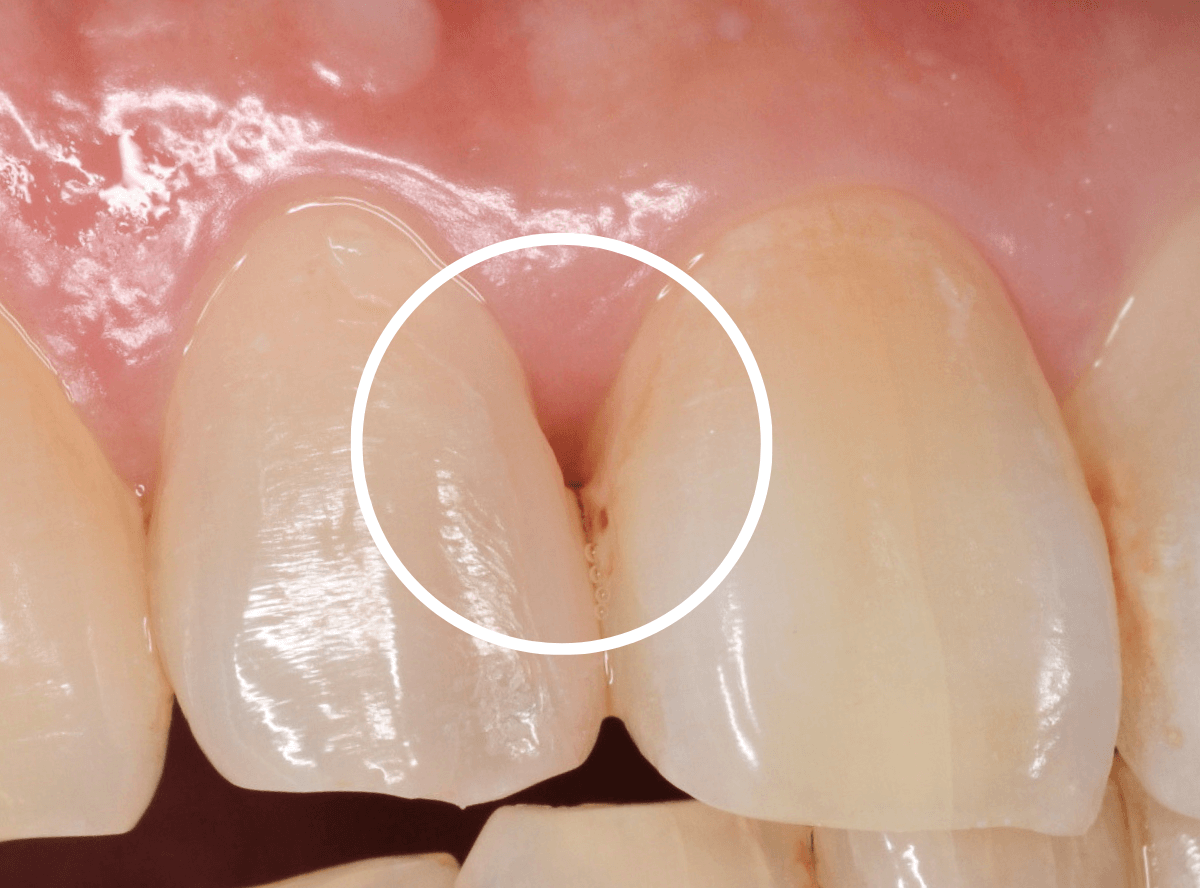 歯肉の中の歯石（歯肉縁下歯石）除去(画像）2-5