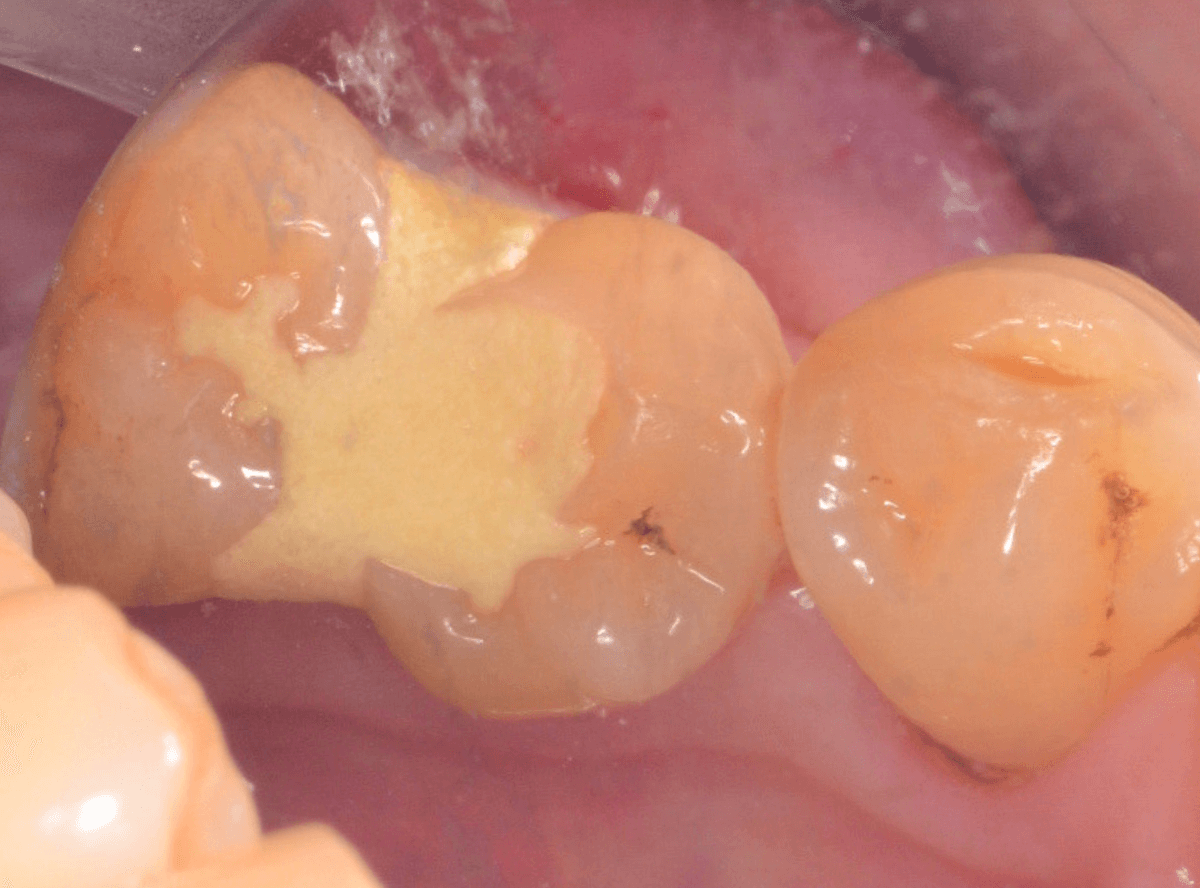 セラミック治療(インレー)1-1