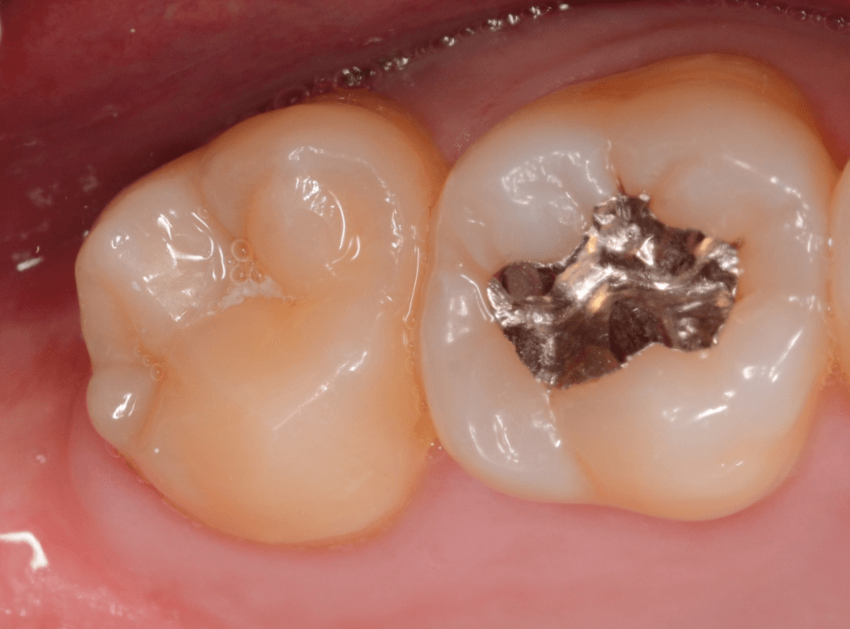 気づかないうちに深い虫歯1-1