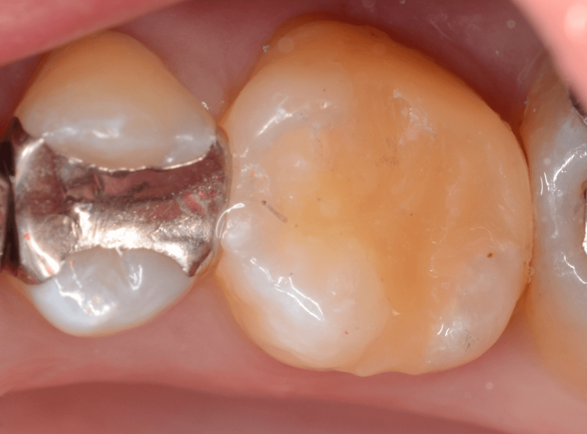 コンポジットレジン治療7-3