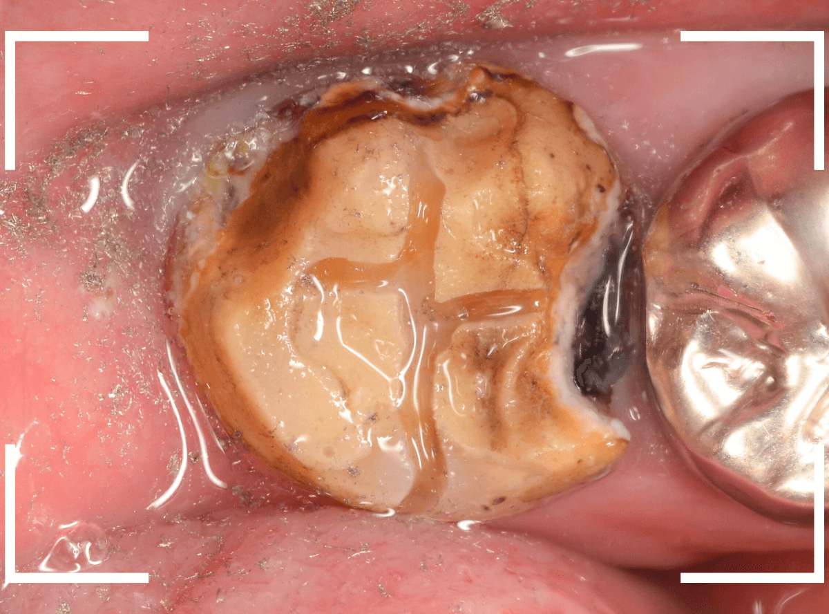 気づかないうちに深い虫歯14-3