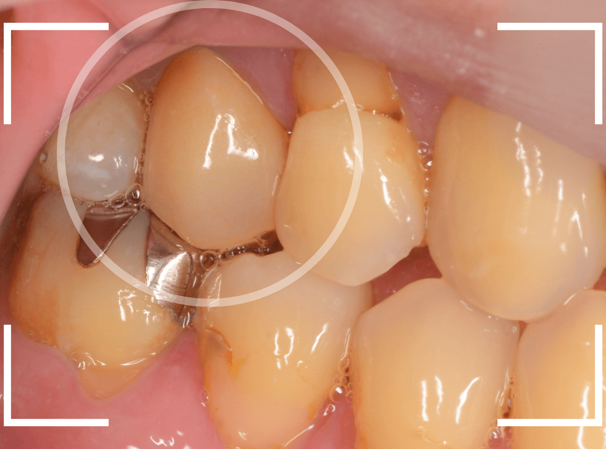 セラミック治療(クラウン・奥歯)8-9