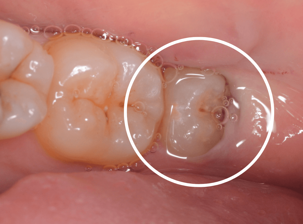 おやしらずの抜歯6-1